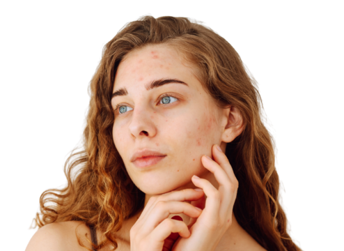Adult Acne Is Rising: Why More Patients Are Struggling Beyond Their Teenage Years